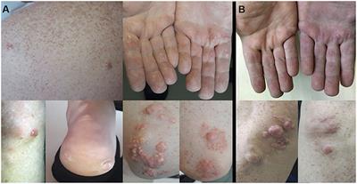 Case Report: Hypertriglyceridemia and Premature Atherosclerosis in a Patient With Apolipoprotein E Gene ε2ε1 Genotype